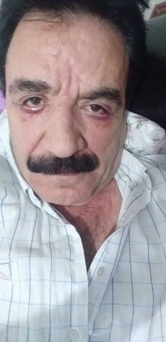 d İstanbul’da ‘göz doktoru hatalı estetik yaptı’ iddiası