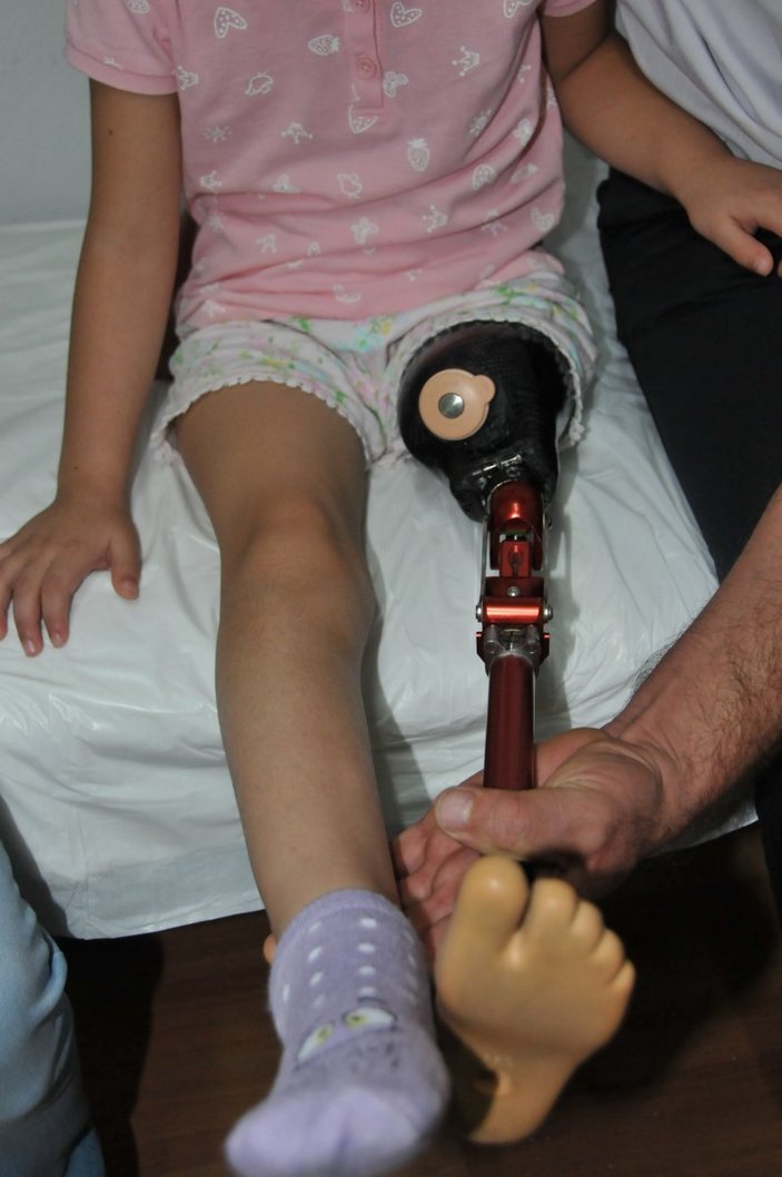 Antalya'da bacağı kesilen Özge’ye silikonlu protez için 30 bin TL gerekiyor