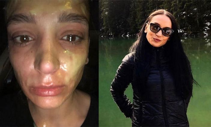 İstanbul'da yüzünde lavabo açıcı patladığını iddia etti: 1,5 milyonluk tazminat davası açtı