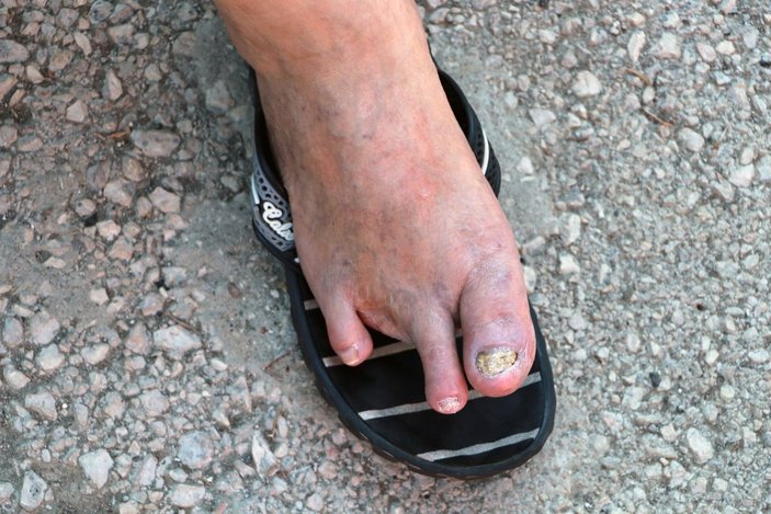 Adana’da sigara yüzünden bacağını kaybeden adam: Beni ibret alın