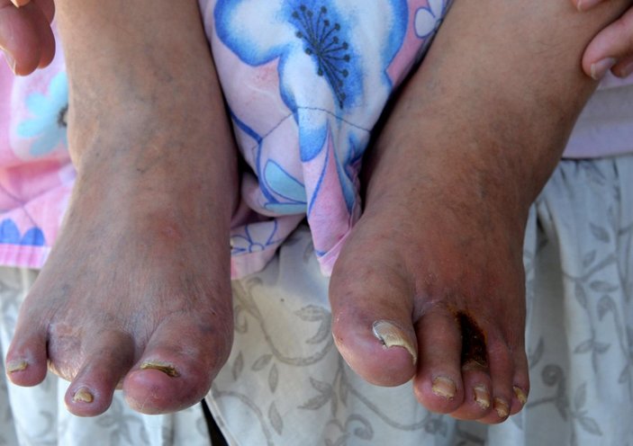 Adana’da sigara yüzünden bacağını kaybeden adam: Beni ibret alın