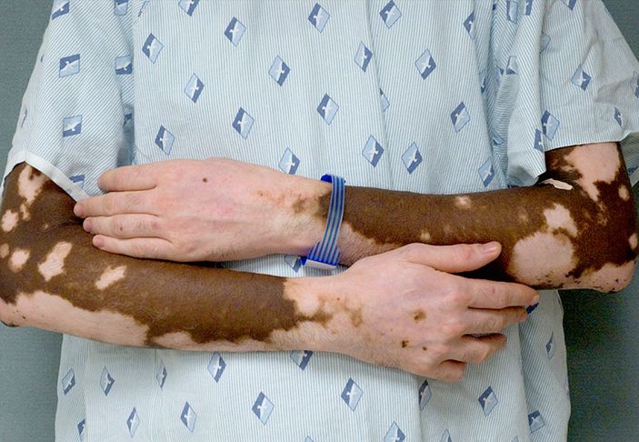 Vitiligo nedir, belirtileri nelerdir? Vitiligo tedavi edilir mi, bulaşıcı mıdır?