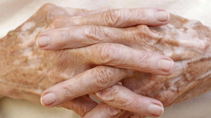 Vitiligo nedir, belirtileri nelerdir? Vitiligo tedavi edilir mi, bulaşıcı mıdır?