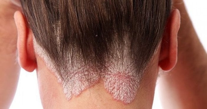 Seboreik dermatit nedir? Seboreik dermatit belirtileri nelerdir, nasıl tedavi edilir?