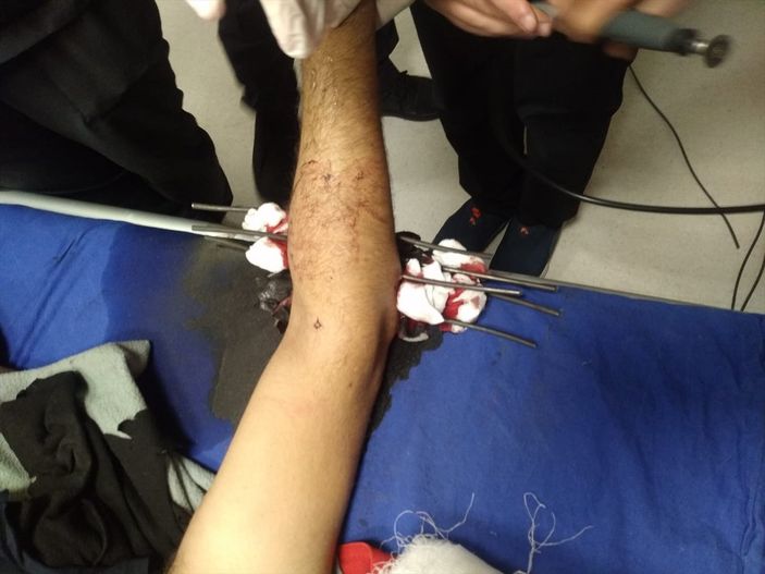 a Sivas'ta YHT inşaatında koluna çelik tel saplanan işçi yaralandı