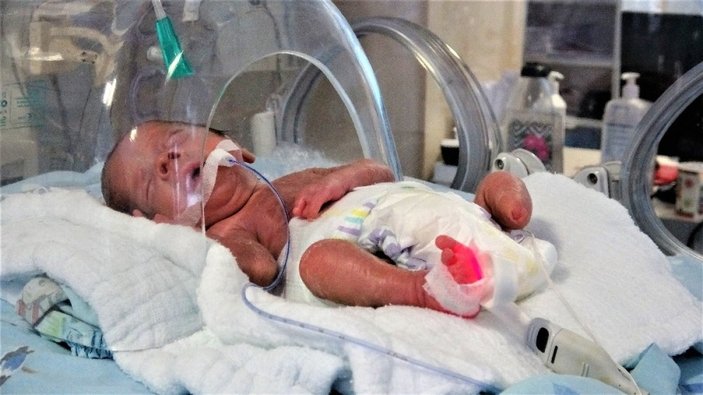 Tokat'ta tek ayaklı doğan prematüre bebek, yaşama tutundu