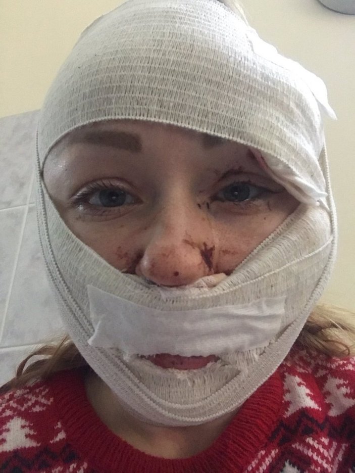 Falçatalı saldırıya uğrayan Anna: Saçımdan tutup, yüzümü kesti