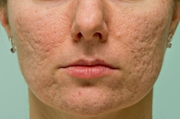 Roaccutane nedir? Sivilceler için Roaccutane nasıl kullanılır? Roaccutane yan etkileri nelerdir?