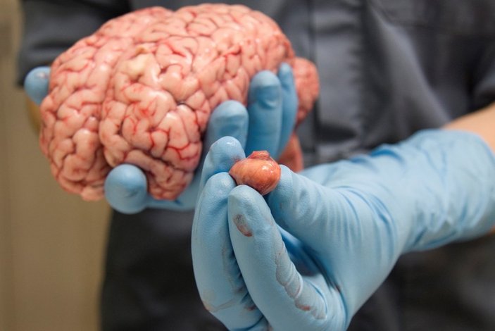 Beyin tümörü nedir, belirtileri nelerdir? Beyin tümörü nasıl anlaşılır, tedavisi var mı?