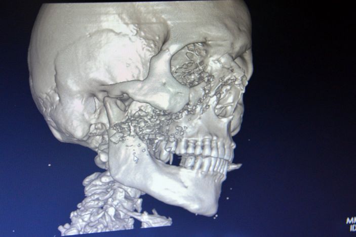 d Kahramanmaraş'ta spiral makinesiyle demir keserken yüzü parçalandı