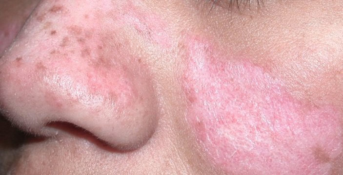 Lupus (kelebek hastalığı) nedir, belirtileri nelerdir? Lupus hastalığı tedavisi var mı?