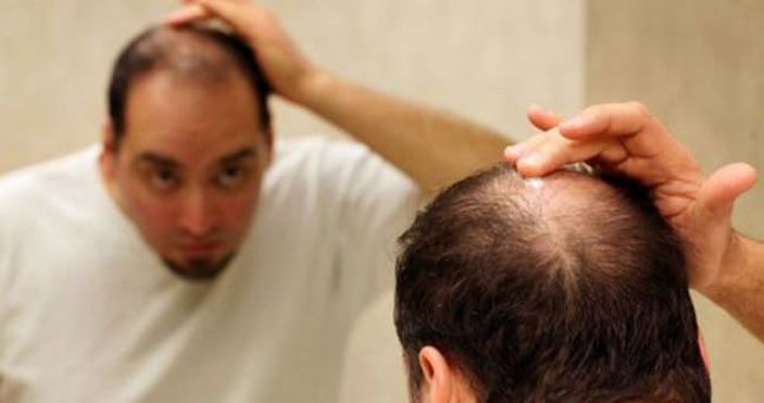 Saçkıran nedir, belirtileri nelerdir? Saçkıran nasıl geçer? Saçkırana iyi gelen yöntemler..