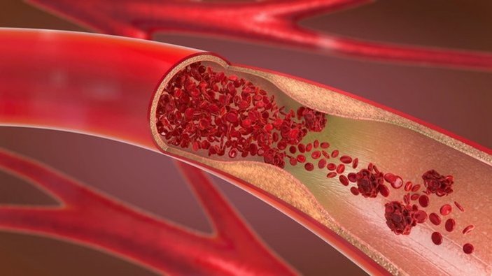 Aort damarı yırtılması nedir, neden olur, belirtileri nelerdir? Aort damarı yırtılması tedavisi var mı?