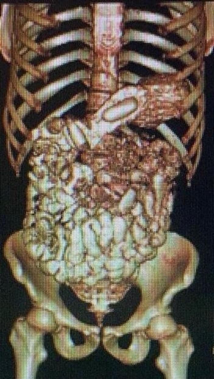 Muş'ta midelerinde uyuşturucu gizleyen 2 kişi yakalandı