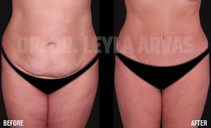 Doğum Sonrası Karın Germe Ameliyatı Ve Meme Estetiği