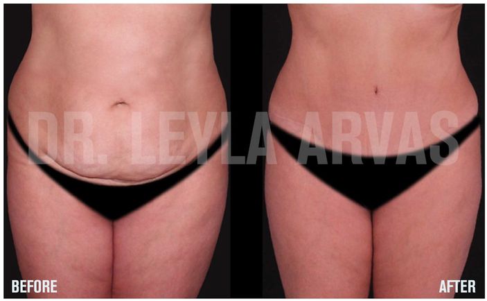 Meme estetiği ile karın germe mükemmele çok yakın