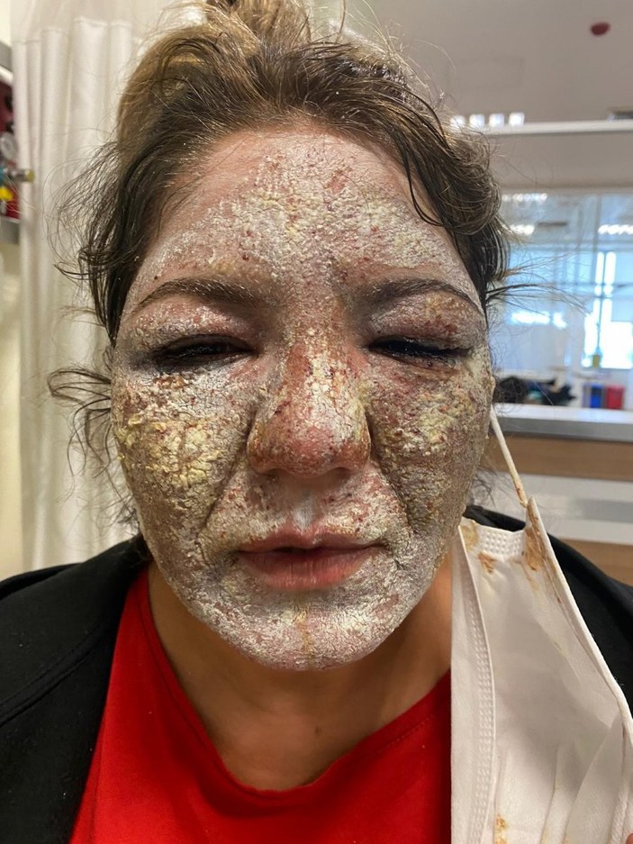 Kahramanmaraş'ta güzellik merkezine giden kadının yüzü yandı