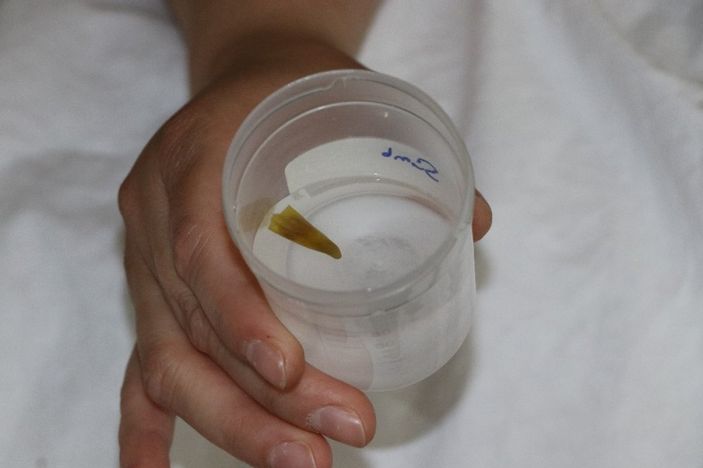 Nefes darlığı çeken kadının ciğerinden biber çıktı