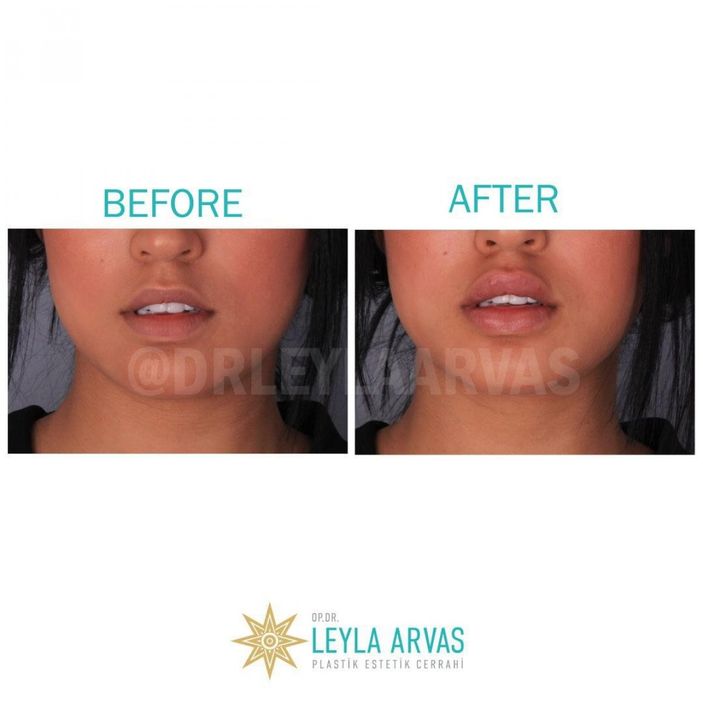 Alt Yüzde Yeni Görünüm. Çene (Jawline) Dolgusu Ve Dudak Dolgusu Kombinasyonu  İle Yenilenin
