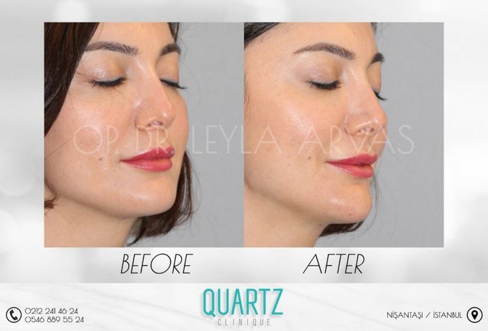 Alt Yüzde Yeni Görünüm. Çene (Jawline) Dolgusu Ve Dudak Dolgusu Kombinasyonu  İle Yenilenin