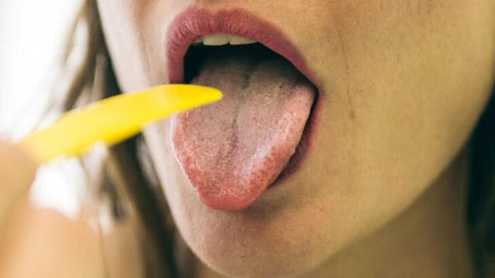 Sjögren sendromu nedir, belirtileri nelerdir? Sjögren sendromu tedavisi var mı?