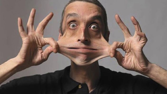 Ehlers Danlos Sendromu nedir, belirtileri nelerdir? Ehlers Danlos (EDS) Sendromu tedavisi var mı?