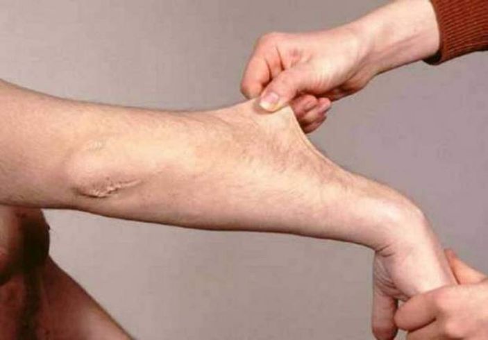 Ehlers Danlos Sendromu nedir, belirtileri nelerdir? Ehlers Danlos (EDS) Sendromu tedavisi var mı?