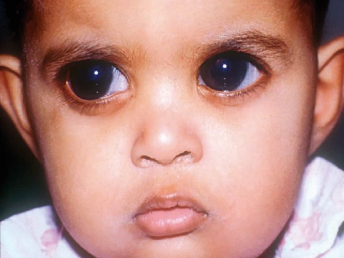 Konjenital glokom nedir, belirtileri nelerdir? Doğumsal göz tansiyonu hastalığı tedavisi var mı?
