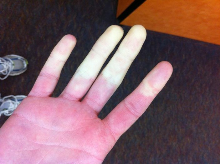 Beyaz parmak hastalığı: Raynaud sendromu nedir? Raynaud (Reyno) sendromu belirtileri nelerdir?