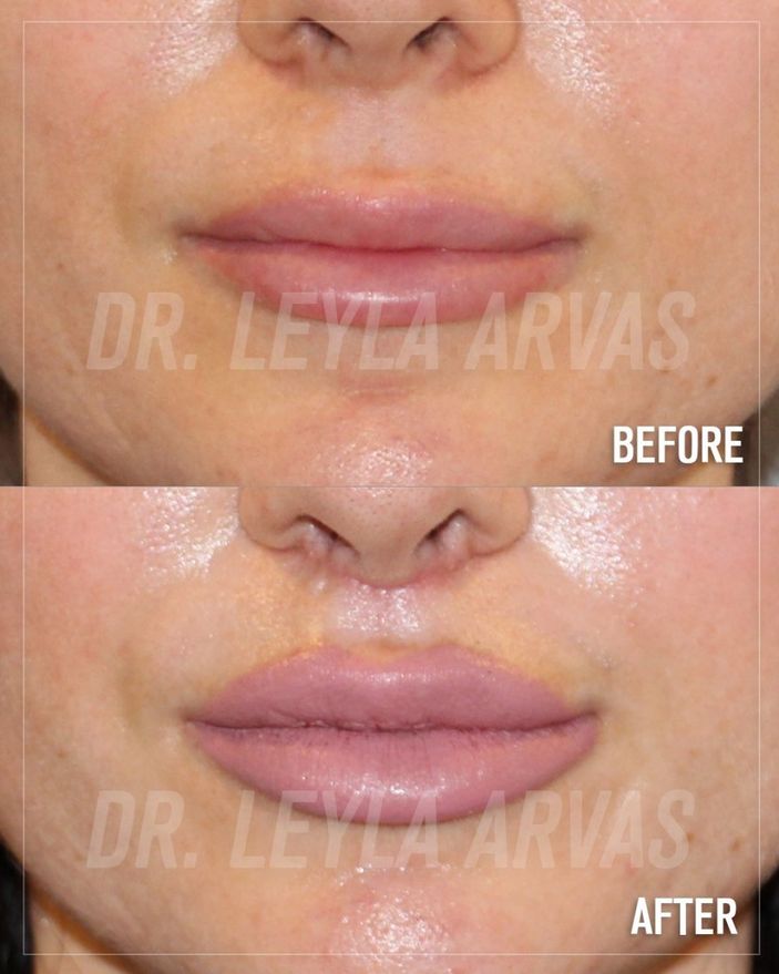 Dudakların mükemmelini yakalayan ikili! Size hangi dudak dokunuşu uygun Liplift mi Dudak dolgusu mu?