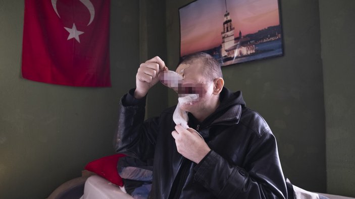 Konya'da cilt kanseri nedeniyle yüzünü kaybetti, hayatı kabusa döndü
