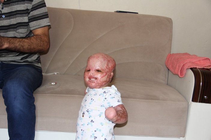 Suriyeli Delal bebek, yanıklarına rağmen hayata tutundu