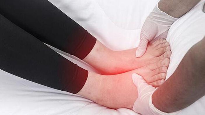 Ödem oluşumunu önlemek için 8 ipucu