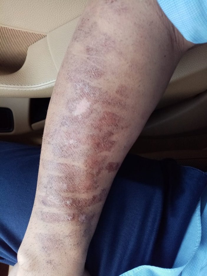 Kahramanmaraş'ta lazer epilasyonda kolları yandı
