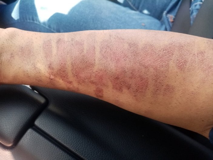 Kahramanmaraş'ta lazer epilasyonda kolları yandı