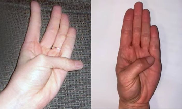 Eliniz, kalp hastalıklarını gösterebilir