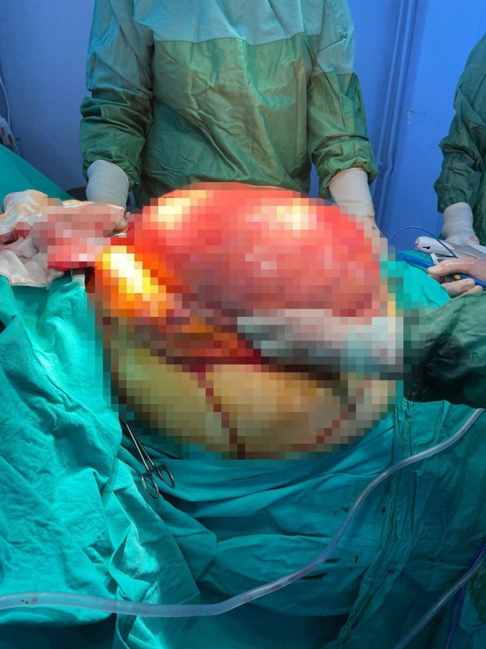 Aydın’da safra kesesi taşı dendi, karnından 15 kilo tümör çıkarıldı