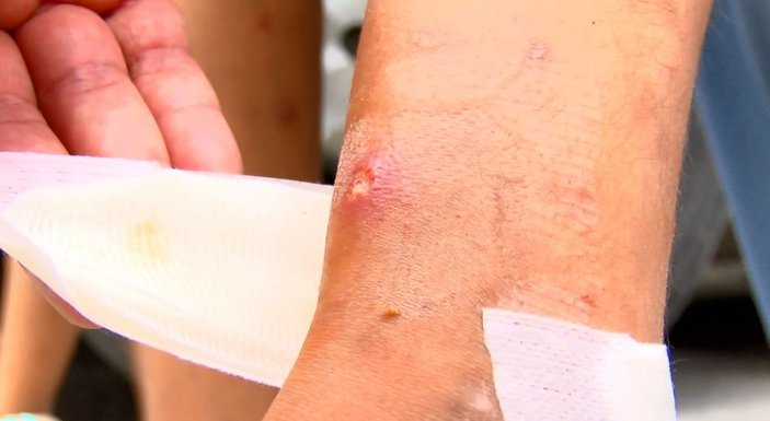 Avcılar’da sivrisinek ısırıkları ile çocuklarda oluşan yaralar paniğe neden oldu