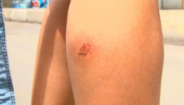 Avcılar’da sivrisinek ısırıkları ile çocuklarda oluşan yaralar paniğe neden oldu