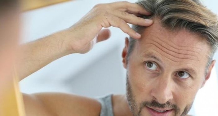 Saç ekimiyle ilgili doğru bilinen 6 yanlış