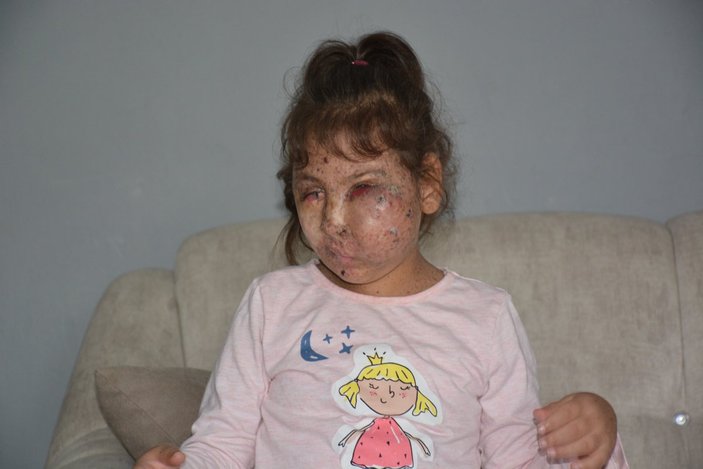 Karabük'te Mikrosefali hastası Sahra, yardım bekliyor