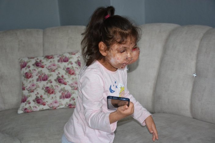 Karabük'te Mikrosefali hastası Sahra, yardım bekliyor