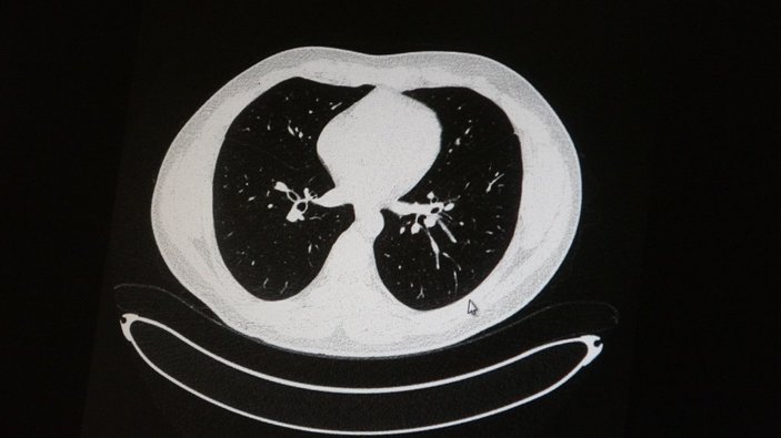 Elazığ’da koronavirüse yakalanan iki gencin tomografisi