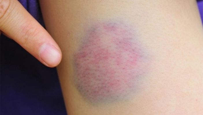 Saç ekimi yaptırmanın riskleri