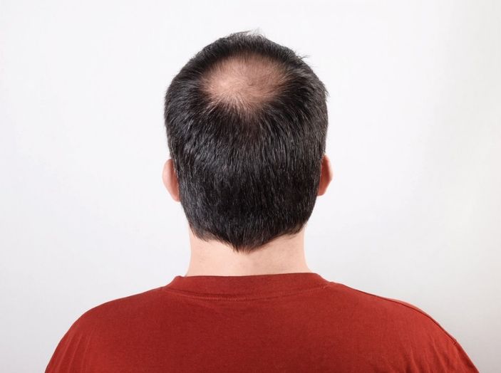 Saç ekimi yaptırmanın riskleri