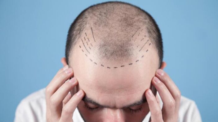 Saç ekimi yaptırmanın riskleri