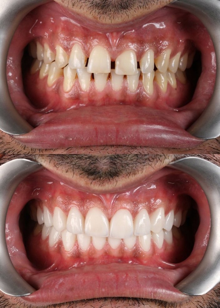 Estetik Diş Hekimliği ve Gülüş Tasarımı