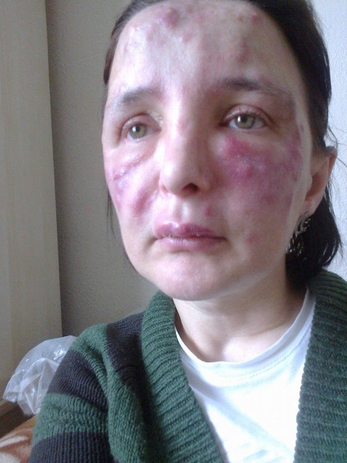 Bakırköy’de kadını tanınmaz hale getiren sahte doktora 3 yıl 4 ay ceza