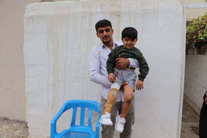 Mardin’de Suriyeli çocuğa protez takıldı