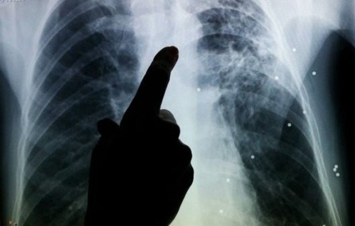 DSÖ: Koronavirüsle mücadele edilirken verem vakaları arttı